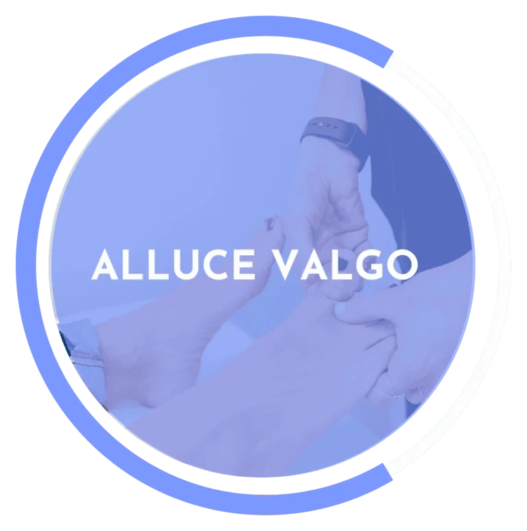 Blog 8 Alluce valgo
