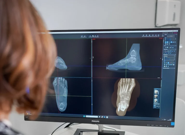 alluce valgo intervento - Alluce valgo recidiva e intervento