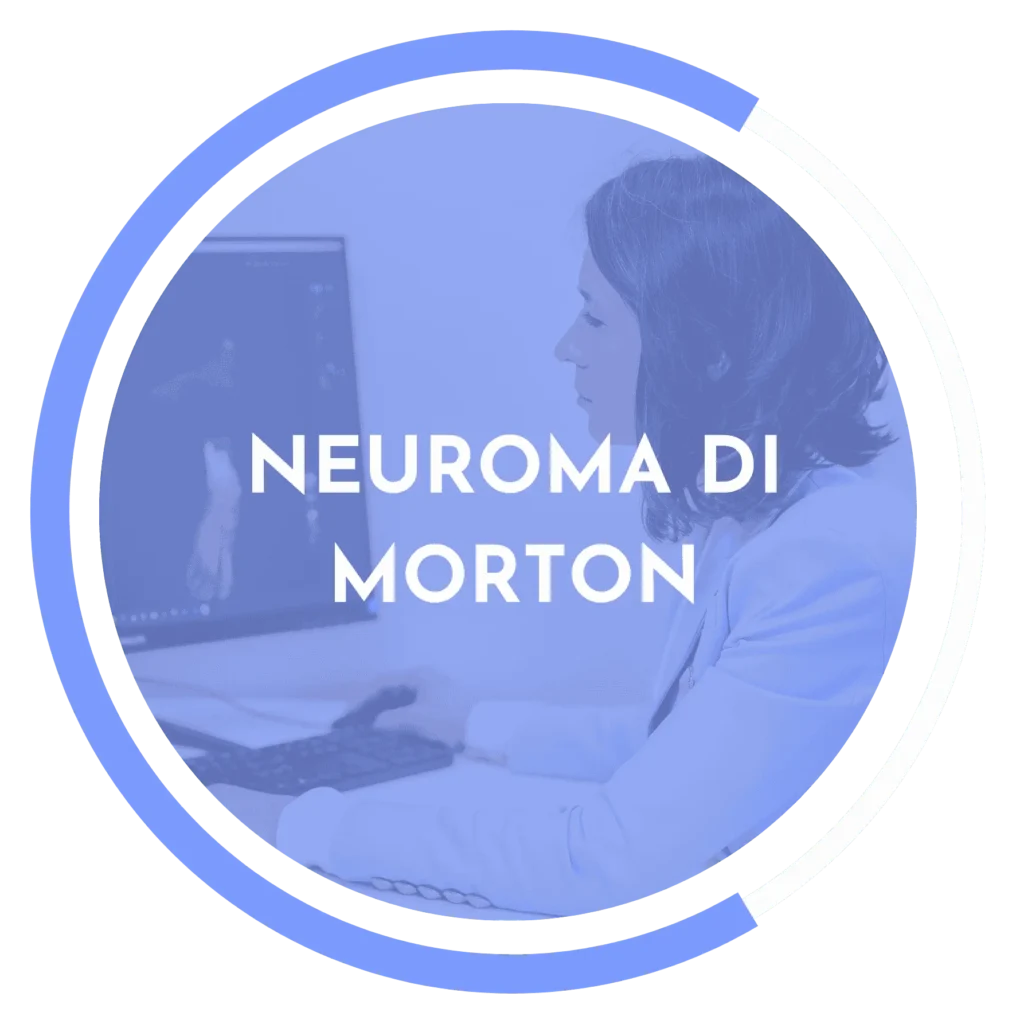 Neuroma di Morton