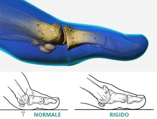 infografica su come si presenta l'alluce rigido e normale