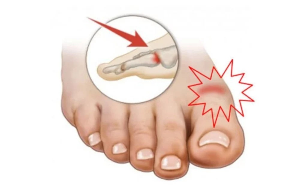dolore all'alluce