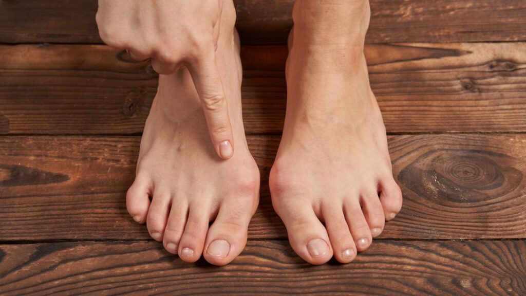 la foto mostra due piedi di cui uno con alluce valgo