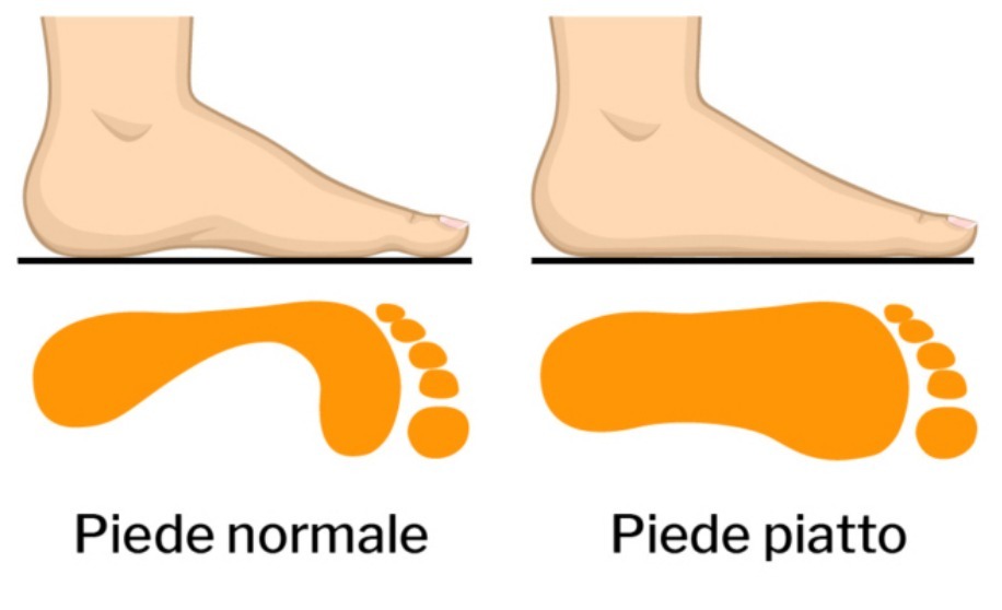 piede piatto infografica che mostra l differenze con un piede normale