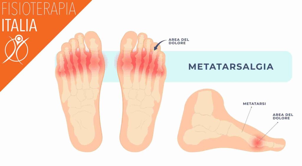 metatarsalgia infografica mostra cos'è