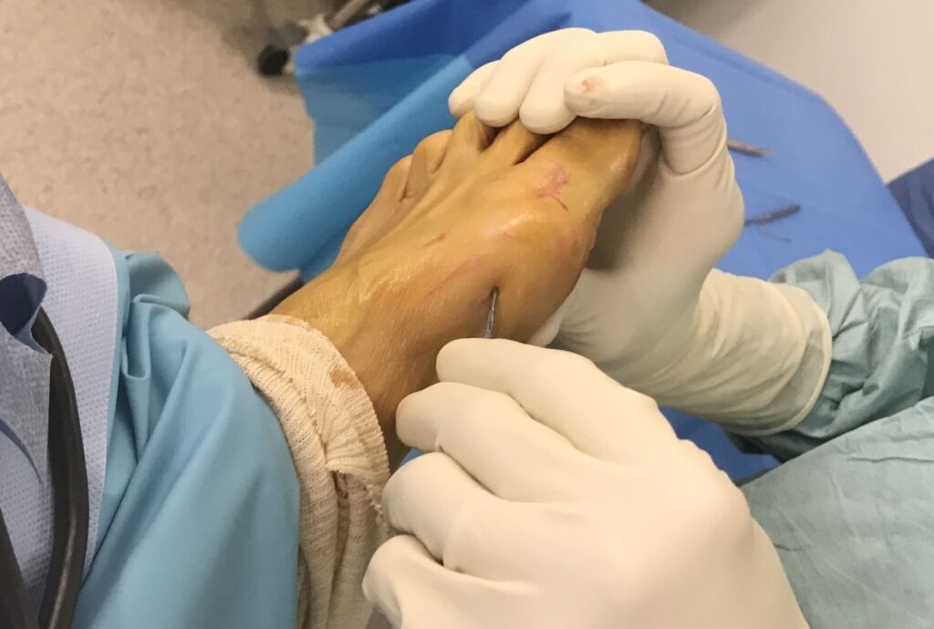 Alluce valgo tecnica percutanea
